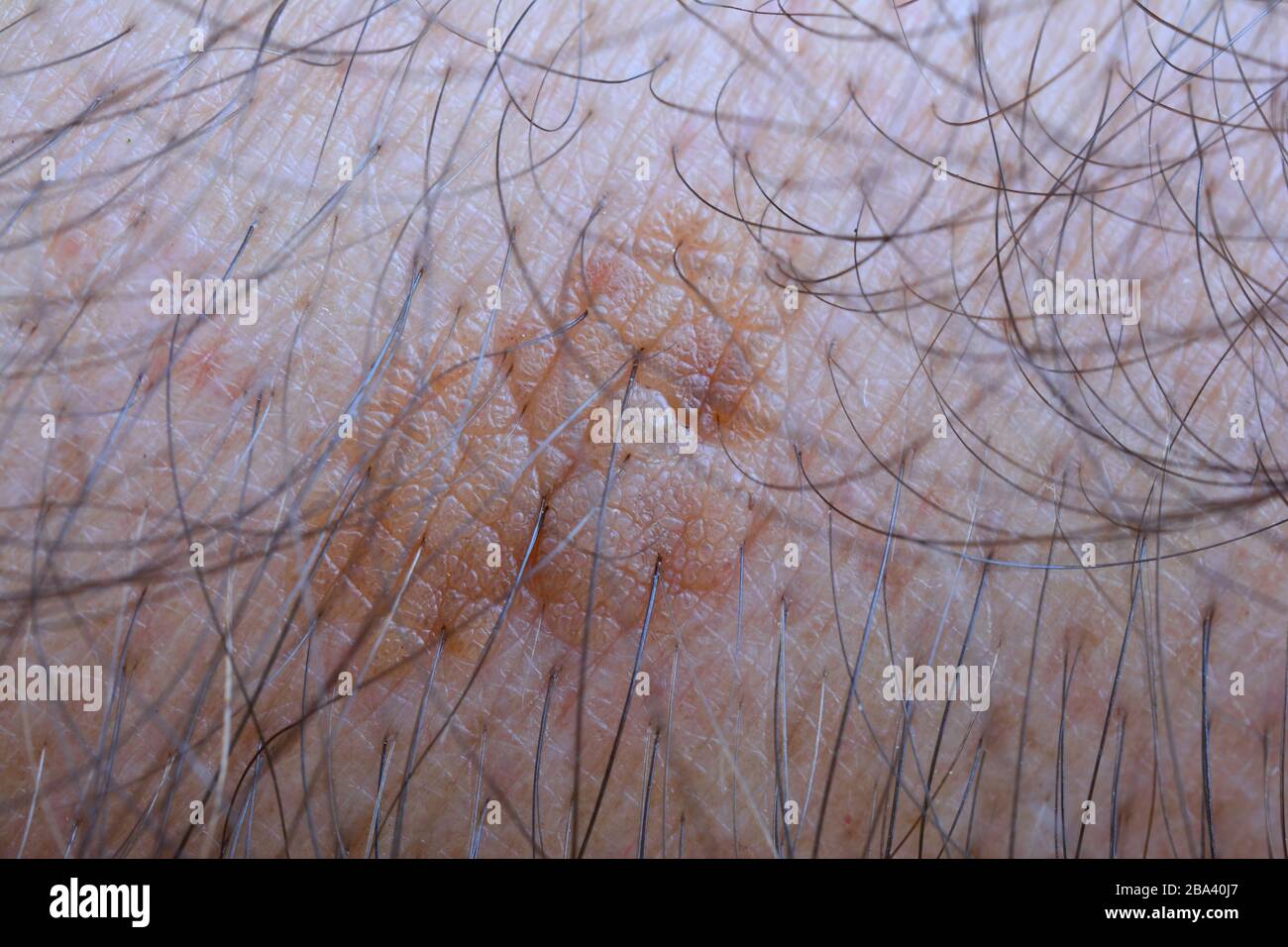 crema-queratosis-seborreica