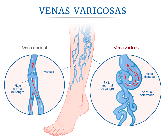 dolor-en-venas