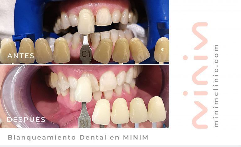 fundas-dientes-farmacia